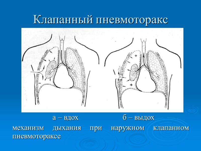 Клапанный пневмоторакс   а – вдох       б